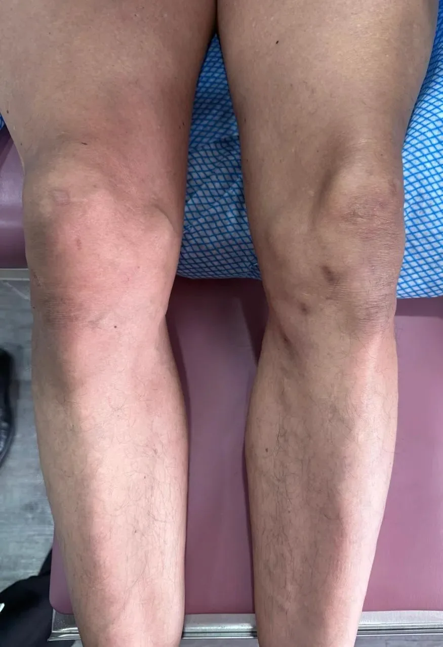 Piernas de paciente tratadas con escleroterapia de venas